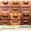 Sugar Advanced Therapy Treatment -huulivoideSugar Advanced Therapy Treatment -huulivoide